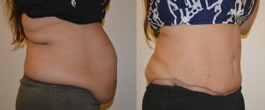 About Abdominoplasty