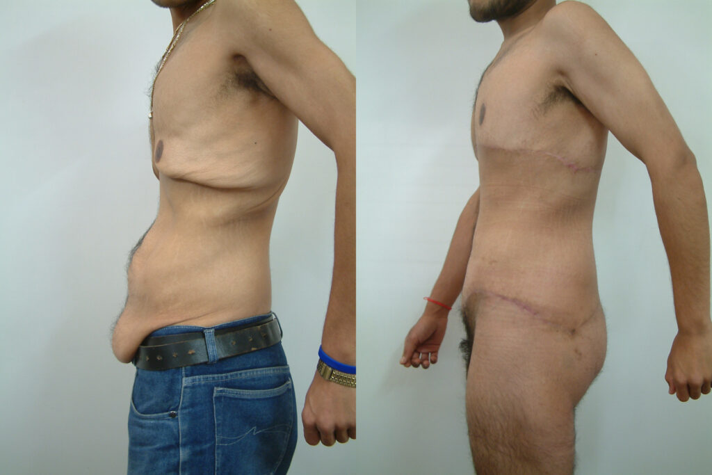 About Otoplasty