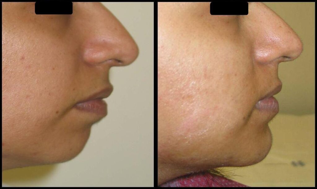About Otoplasty