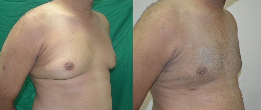 About Gynecomastia