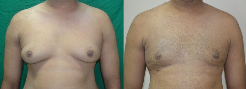 About Gynecomastia