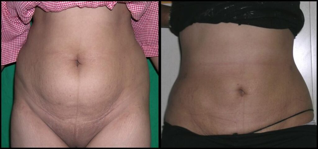 About Liposuction
