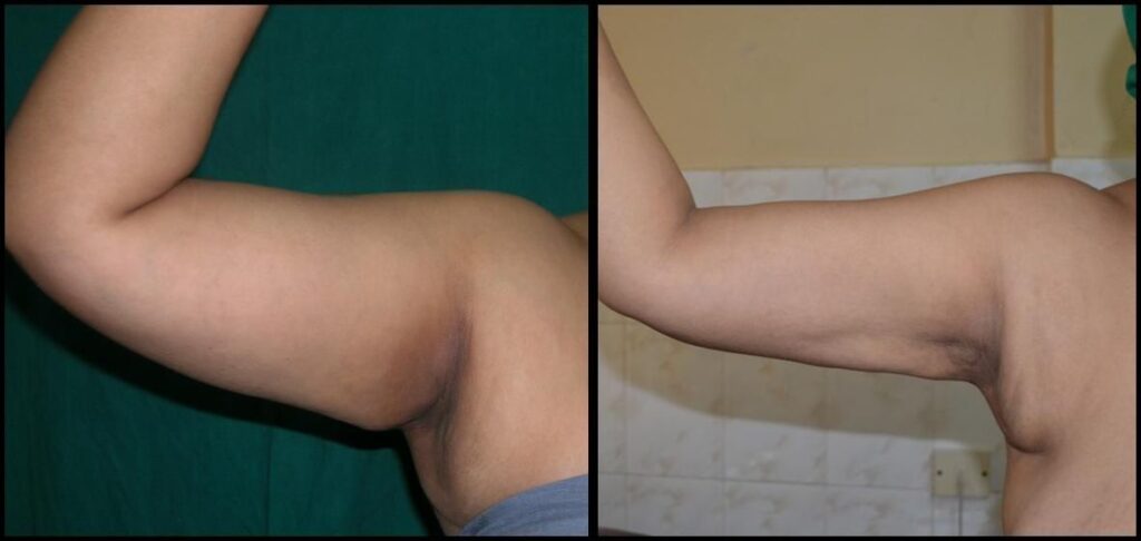 About Liposuction