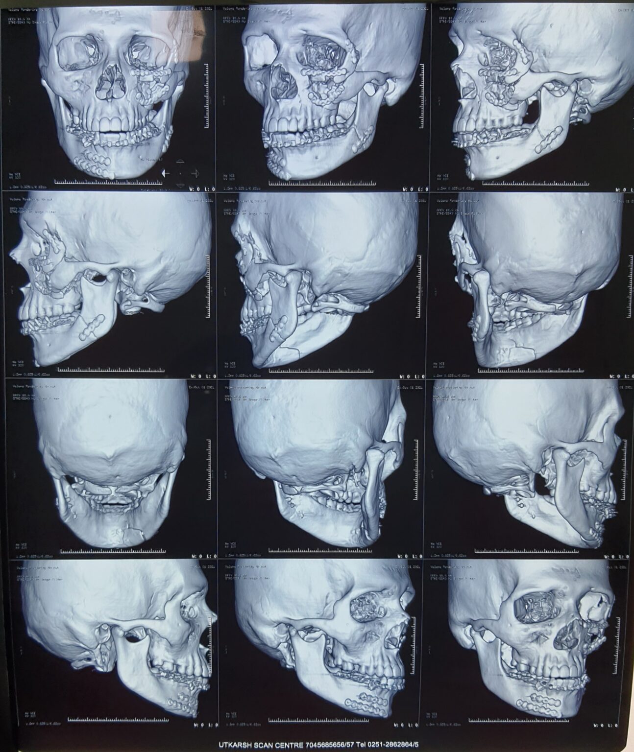 About Abdominoplasty