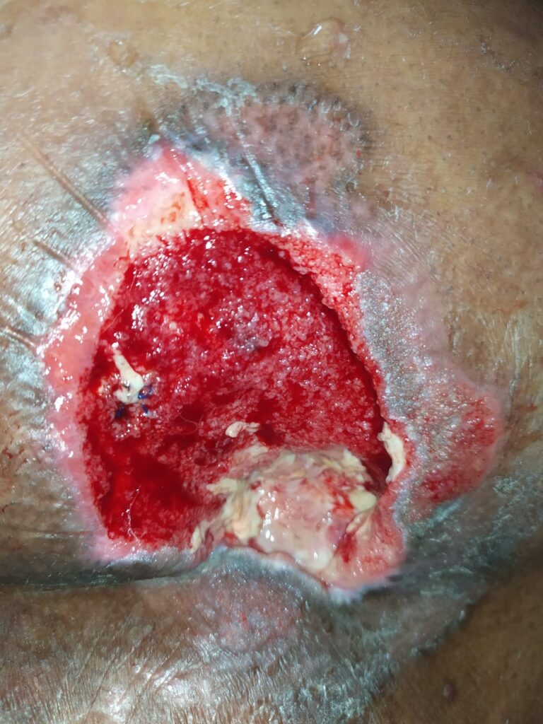 About Abdominoplasty