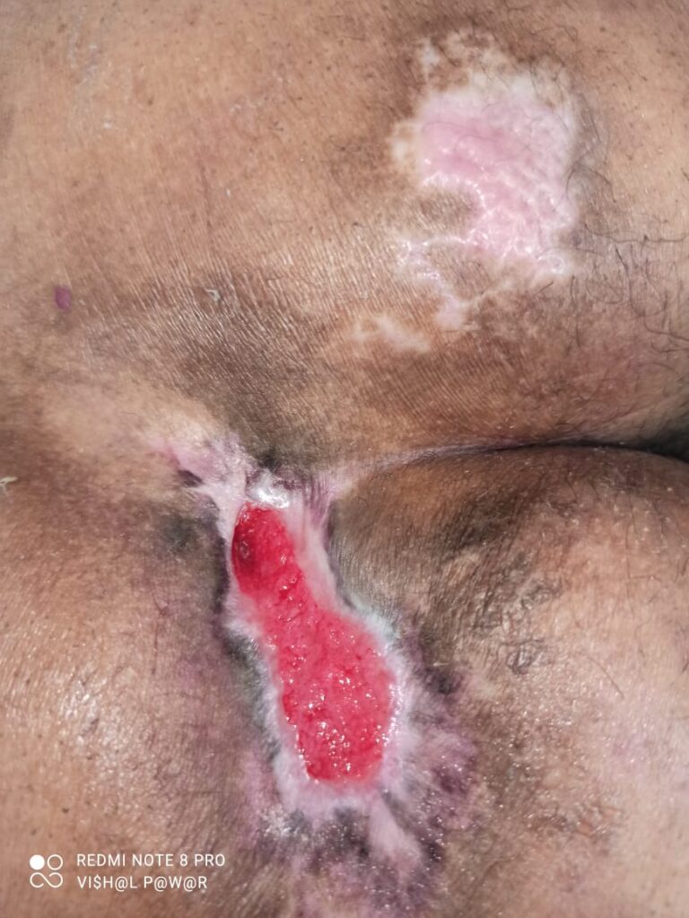 About Abdominoplasty