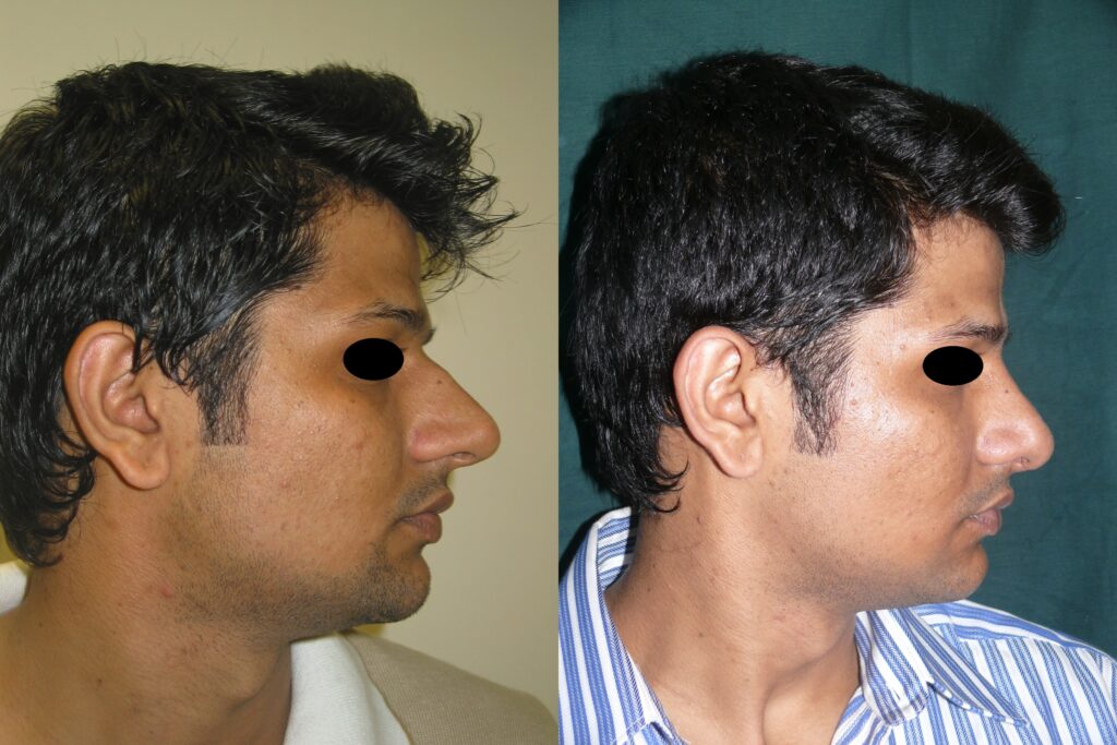 About Abdominoplasty