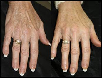 About Otoplasty
