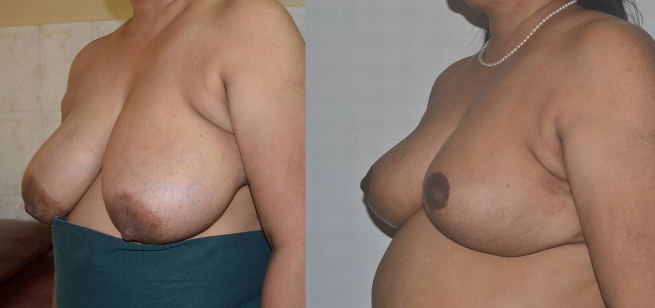 About Breast Reduction