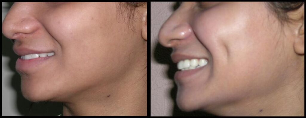 About Dimple Creation Surgery