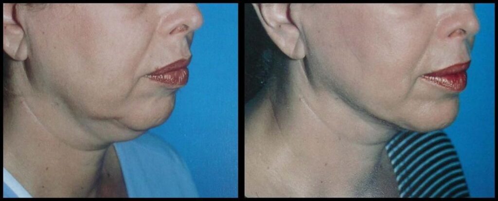 About Face Lift