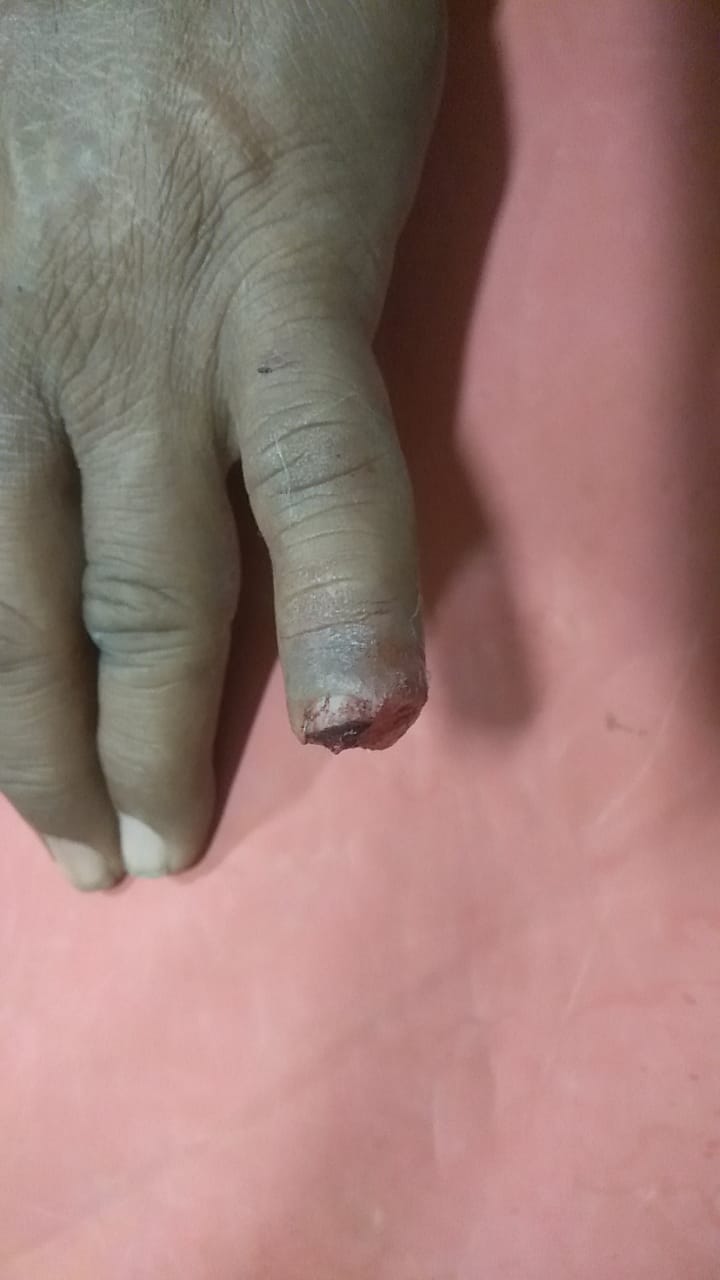 Hand Surgery Patient 5 - Case 1