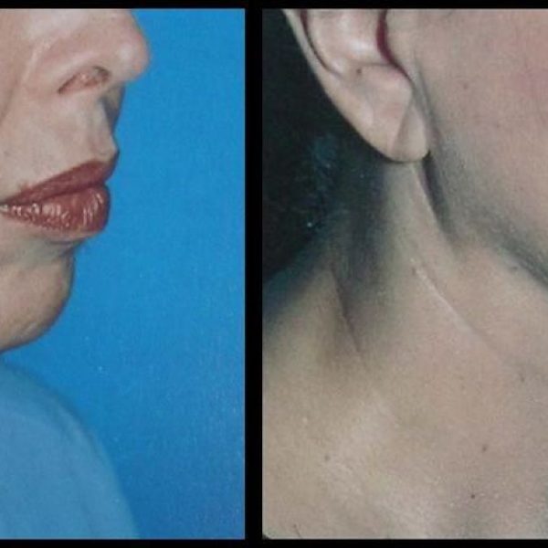 About Neck Lift