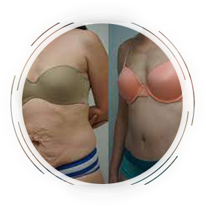 Abdominoplasty