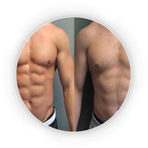 Six Pack Abdominoplasty